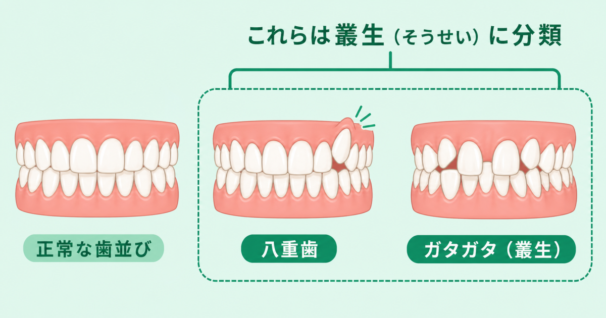 ■八重歯・ガタガタの正体は「叢生(そうせい)」
