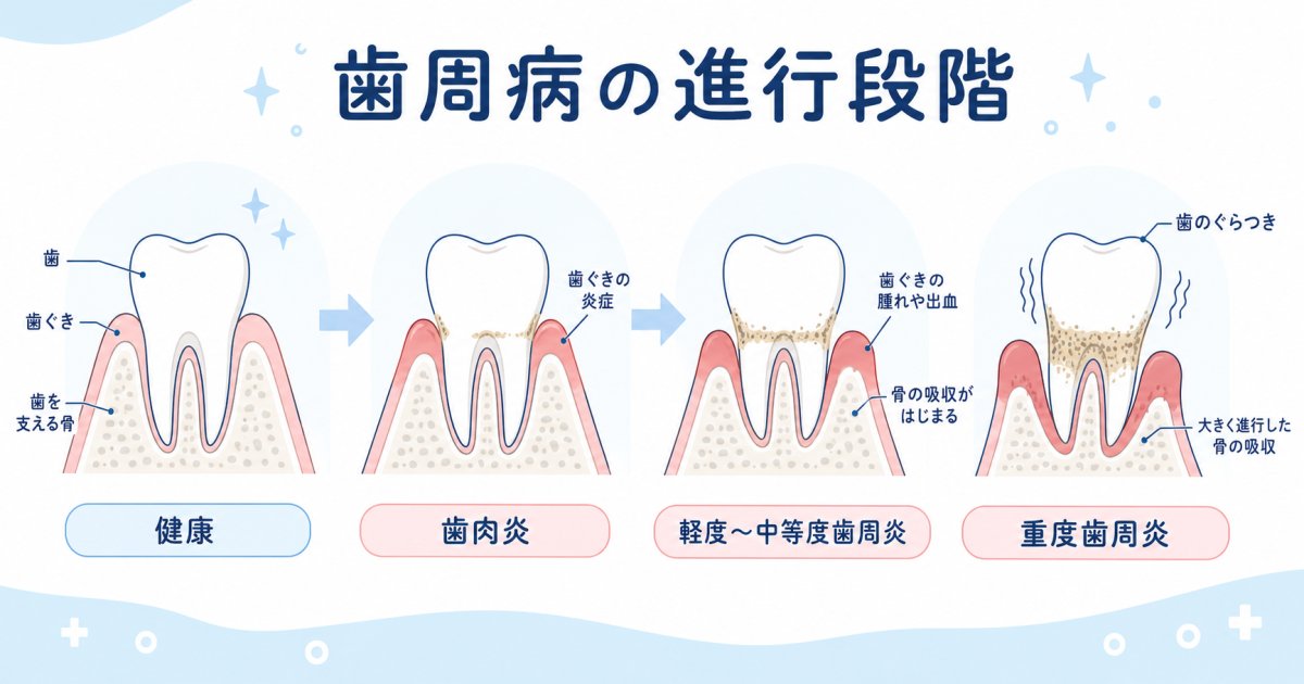 歯周病の放置で歯が抜ける？進行段階と手遅れを防ぐ治療法を解説