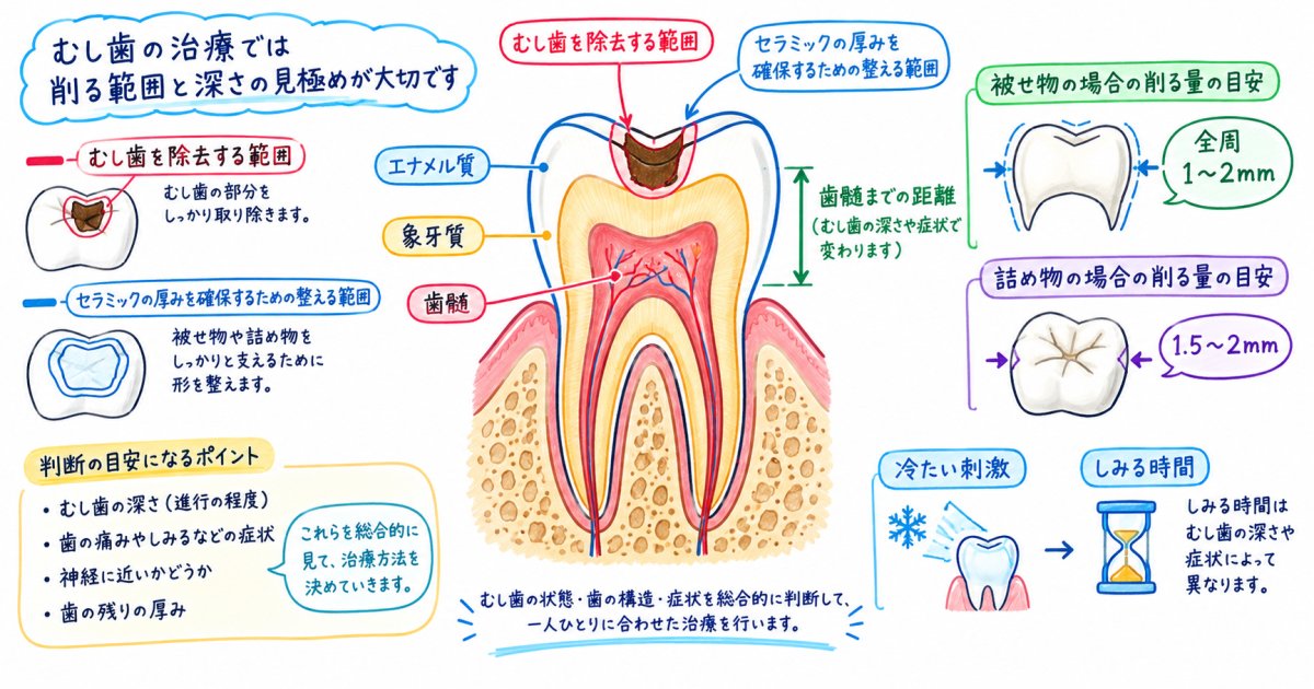 セラミックで歯を削る量はどれくらいか、神経を残せる条件まで整理